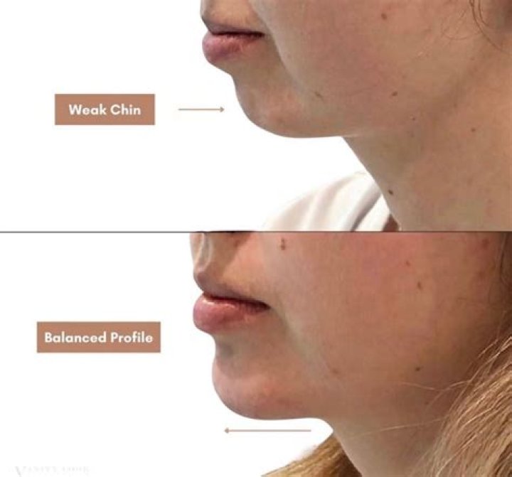 How can I hide my weak jawline?