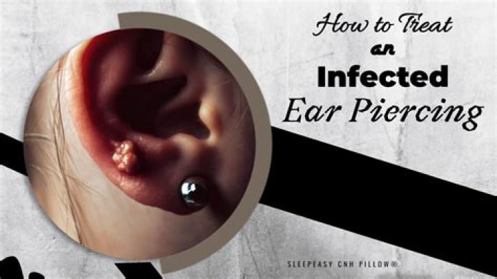 How do you treat an infected piercing bump?
